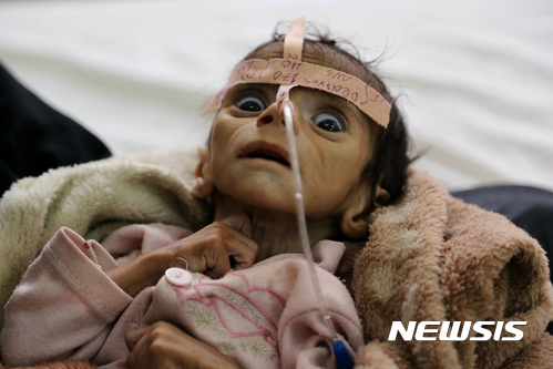 【사나(예멘)=AP/뉴시스】지난 3월24일 심각한 영양실조로 숨진 예멘 아기 우다이 파이살의 숨지기 이틀 전 모습. 예멘 내전이 2년 넘게 계속되면서 예멘은 경제가 황폐화되고 기아가 확산되는 등 큰 재앙에 처했다. 유엔은 예멘 전체 어린이의 약 80%가 즉각 인도적 지원을 필요로 한다고 26일 밝혔다. 2017.7.27