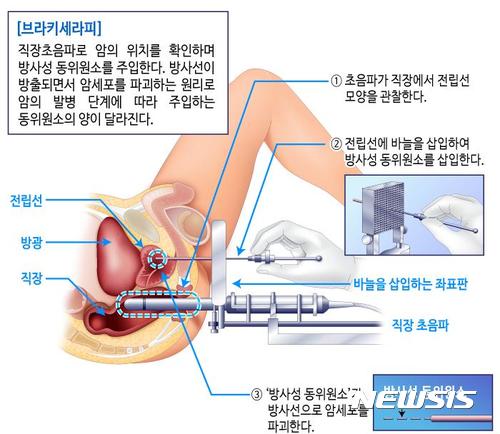  ▲ MRI와 초음파영상 융합한 전립선암 '브라키세라피' 시술 모식도.