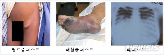 [세종=뉴시스]증상별 페스트가 진행된 모습. (사진=질병관리본부 제공)