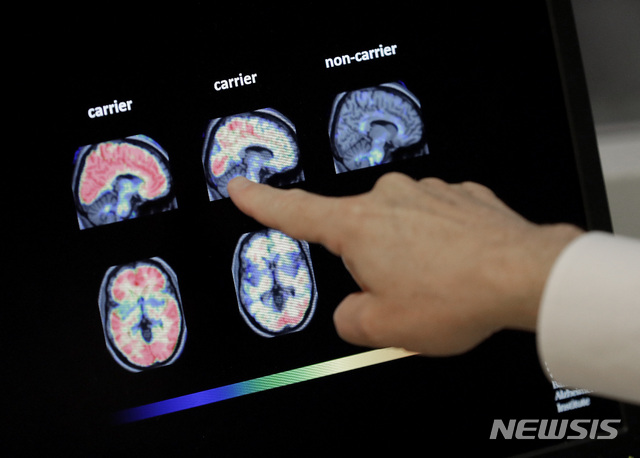 [AP/뉴시스] 2018년 8월 자료사진으로 미국 애리조나주 피닉스 병원에서 한 의사가 PET 뇌 스캔을 보고 있다
