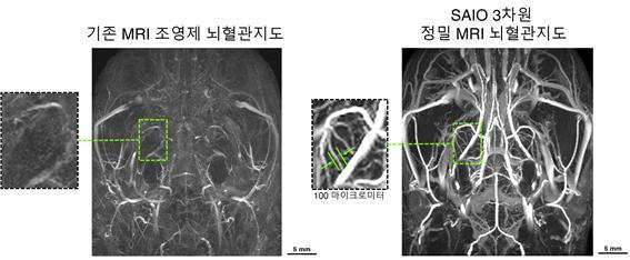 기존 MRI 조영제를 사용한 뇌혈관 지도(왼쪽)와 최근 개발된 사이오를 사용한 뇌혈관지도. (사진=연세대 세브란스병원 제공) *재판매 및 DB 금지