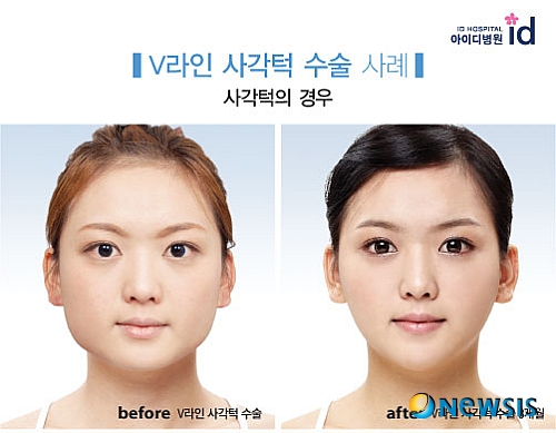 사각턱 때문에 긴 머리만 고수한다면 'V라인사각턱' 수술이 제격