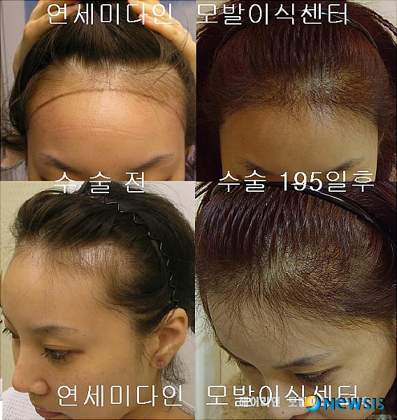 헤어라인 교정과 자연스러운 개선을 위한 합리적인 가격