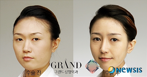 부평코수술 얼굴 중심의 입체감을 세우기 위해