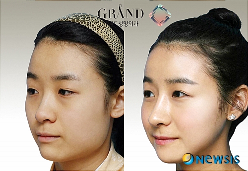 V라인의 적 사각턱 