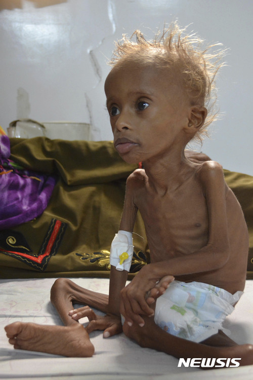 【호데이다(예멘)=AP/뉴시스】예멘 사나 호데이다의 한 병원에 영양실조로 뼈만 앙상하게 남은 아기가 힘없이 앉아있다. 사진은 지난해 9월 9일 촬영됐다. 2017.11.17