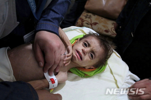 【OCHA·AP/뉴시스】유엔 인도주의업무조정국(OCHA)이 10월 30일 제공한 시리아의 기아상태 어린이의 모습 사진. 수도 다마스쿠스 인구 동구타주 카프르 바트나 병원에서 의료진이 한 어린이의 팔뚝 둘레를 재고 있다. 2017.12.15 