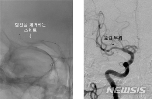 【부산=뉴시스】 제갈수만 기자 = 인제대학교 해운대백병원 신경외과 진성철 교수팀은 뇌경색 환자를 대상으로 막힌 뇌혈관을 뚫어 최악의 상황을 막아주는 '하이브리드 혈전 제거술'로 기존의 치료법보다 나은 결과를 나타내고 있다고 12일 밝혔다. 사진은 시술전과 후의 혈관 모습이다. 2018.06.12. (사진= 해운대백병원 제공)  photo@newsis.com