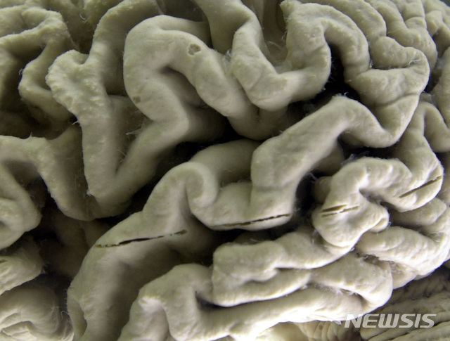 [서울=뉴시스버팔로( 미 뉴욕주) = AP/뉴시스] 뉴욕주 버팔로 신경해부학 박물관에 전시되어 있는 알츠하이머 환자의 손상된 뇌사진. 미국의 제약사들은 7월25일 시카고에서 열린 국제 알츠하이머협회 총회에서 신약 BAN2401의 최고용량을 투약한 환자들의 임상실험에서 30%의 환자들이 뇌혈관의 플라그가 사라지는등 효과를 보였다고 발표했다.   