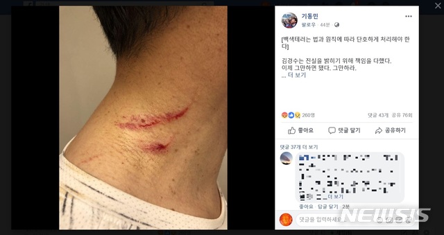 【서울=뉴시스】기동민 더불어민주당 의원이 자신의 페이스북에 올린 김경수 경남지사의 상처 사진. (사진 = 기동민 의원 페이스북 캡쳐) 2018.08.10.  photo@newsis.com 