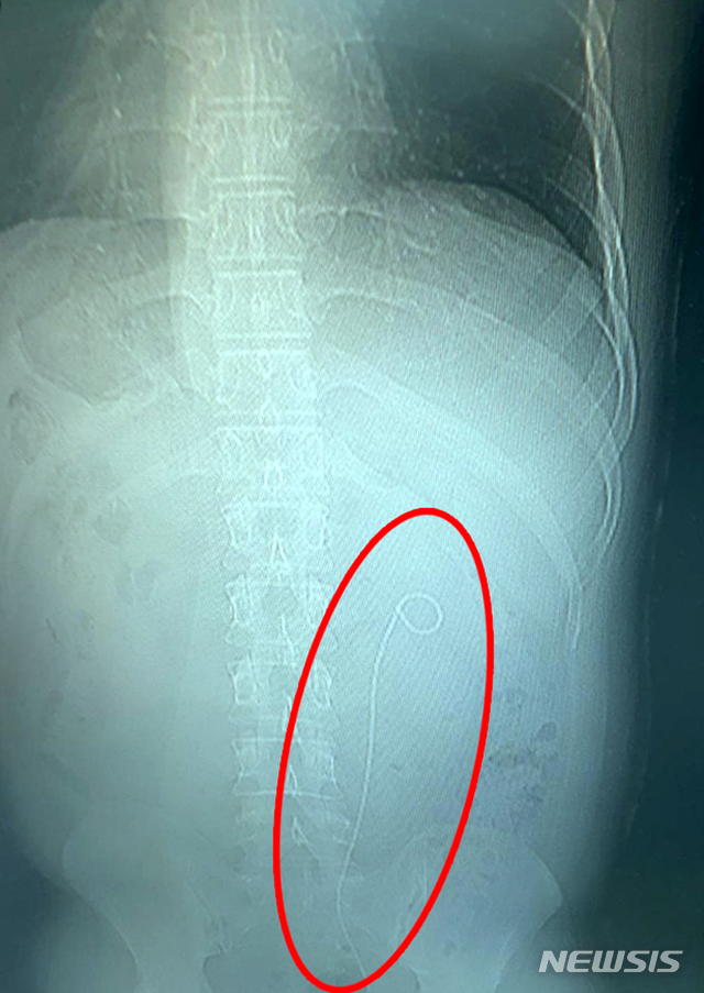  【광주=뉴시스】구용희 기자 = 30대 결석 환자 몸속에서 발견된 수술기구. 이 환자는 지난 2015년 광주 모 대학병원에서 결석 제거 수술을 받았다. 이후 지난 10월 같은 병원에서 진단서를 발급받기 위해 영상검사를 받는 과정에 당시 수술에 사용했던 기구가 몸속에 남아 있다는 사실을 발견했다. 2018.12.18. (사진 = 해당 30대 환자 제공)persevere9@newsis.com