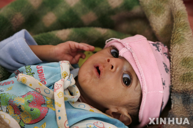 【사나(예멘)=신화/뉴시스】19일(현지시간) 예멘 수도 사나의 한 영양실조 케어센터에서 영양실조에 걸린 어린이가 치료를 받고 있다. 한 인권단체는 예멘 인구의 약 절반에 해당하는 1,430만 명이 극도의 빈곤층으로 분류되며 이 중 5세 미만 어린이 200만 명을 포함한 약 320만 명은 급성 영양실조로 치료를 받아야 한다고 밝혔다. 2019.02.20.