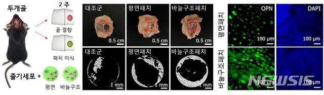 【서울=뉴시스】나노바늘구조 지압패치의 골 조직 재생. 두개골 손상 쥐 모델에 줄기세포가 결합된 나노바늘구조 지압패치를 삽입하고 2주 후에 두개골 조직 재생을 확인했다. 두개골 조직 재생이 촉진되고 골 형성 관련 단백질 마커(marker) 발현이 향상되는 것을 확인할 수 있었다. (그림/김장호 전남대 교수, 정훈의 울산과학기술원 교수 연구팀 제공) photo@newsis.com