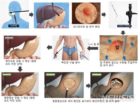[서울=뉴시스] 알긴산 기반 근적외선 형광 수술 표지자를 이용한 정밀 위암 수술 모식도