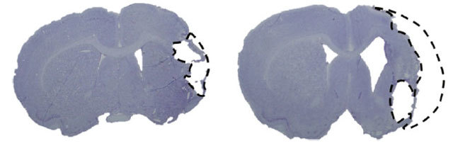 [서울=뉴시스] 유도만능줄기세포 유래 신경전구세포를 이식한 그룹(왼쪽)의 뇌경색 부피가 대조군(오른쪽)에 비해 약 30% 정도 감소했다.(사진=차 의과학대학교·차병원 제공)