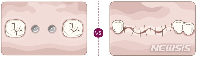임플란트, 진료일 뻥튀기한 치과의사-보험사 속인 환자