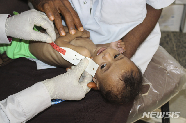 [데이르알하시=AP/뉴시스]지난 14일(현지시간) 예멘 데이르 알 하시의 한 병원에서 생후 7개월 된 이사 이브라힘 나제르가 신체검사를 받고 있다. 이 아이의 체중은 불과 3kg으로 예멘에는 수백 명의 아이가 가난과 갈등으로 극심한 영양실조에 시달리고 있다. 2020.06.29.