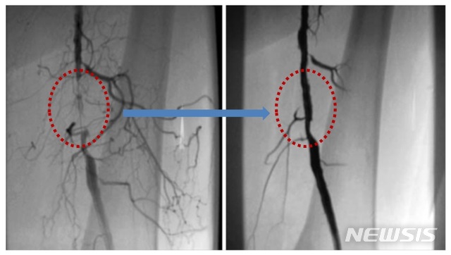 [서울=뉴시스] 좁아진 대퇴동맥에 풍선확장술 시행(왼쪽), 시행 후 정상적인 혈류 흐름을 보인다.(오른쪽) (사진=강동경희대병원 제공). 2020.11.25.