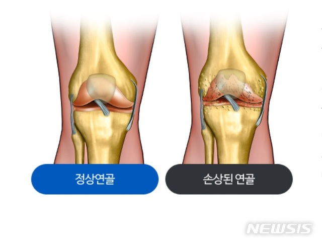 [서울=뉴시스] 정상 연골과 손상된 연골. (그림=힘찬병원 제공). 2020.12.02.