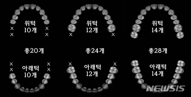 [서울=뉴시스] 한국인은 위아래 큰어금니가 2개씩 맞물려야 정상적인 식사를 할 수 있다. (사진=강동경희대병원 제공). 2020.12.23.