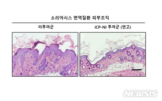 자가면역질환 소리아시스(건선) 질병모델에서 과도한 염증반응에 의해 비정상적으로 각질층이 붕괴되고 경화돼 불규칙하게 파괴된 피부조직(왼쪽)을 iCP-NI가 정상화시킴(오른쪽) (사진=셀리버리 제공)