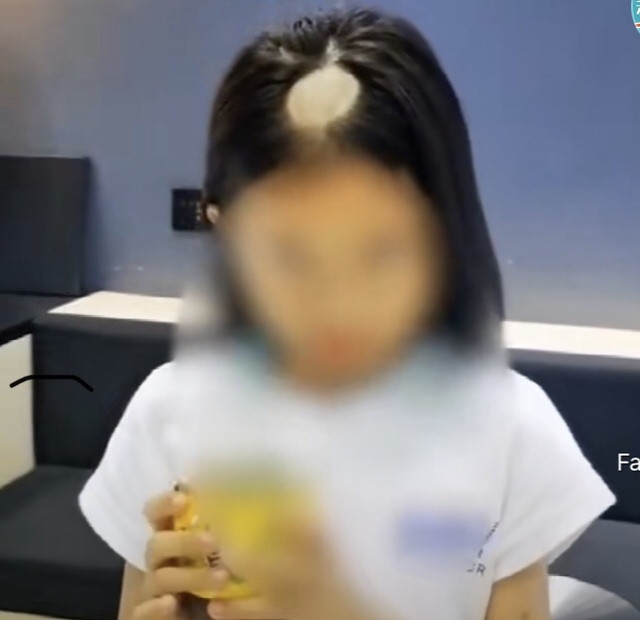 [서울=뉴시스]반려묘로 인해 원형 탈모증을 앓는 한 중국 소녀 (사진=웨이보)