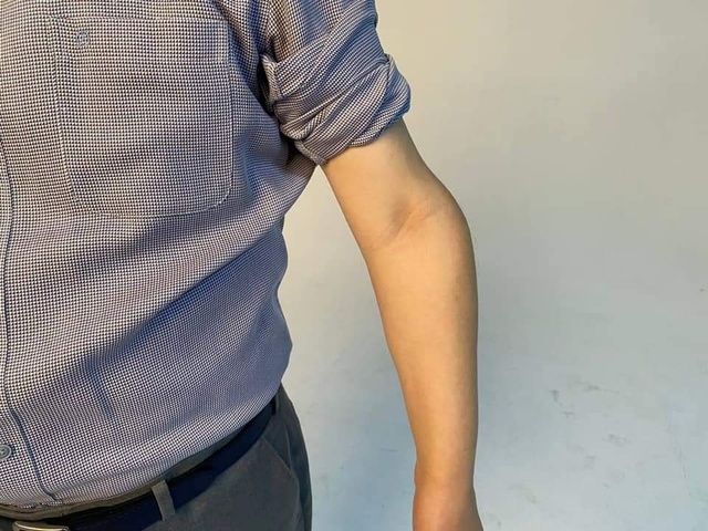더불어민주당 유력 대선주자인 이재명 경기지사는 17일 자신의 군미필이 논란이 되자 페이스북에 소년공 시절 부상으로 장애를 입은 왼팔 사진을 올렸다. (사진=이재명 페이스북) 