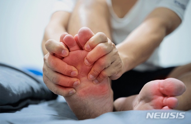 [서울=뉴시스]통풍은 체내에 요산이 과다 축적돼 발생하는 관절염이다. 말 그대로 바람만 스쳐도 아픈 병으로, 관절이 갑자기 벌겋게 부어오르면서 심한 통증이 야기된다. (사진= 분당서울대병원 제공) 2021.08.19