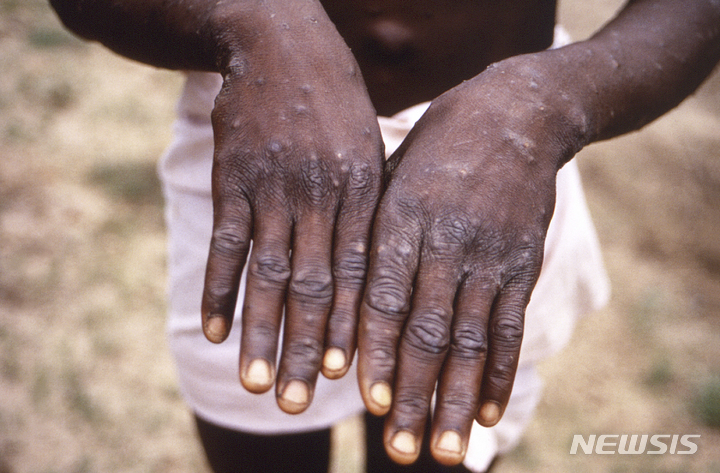 This 1997 image provided by the CDC  during an investigation into an outbreak of monkeypox, which took place in the Democratic Republic of the Congo (DRC), formerly Zaire, and depicts the dorsal surfaces of the hands of a monkeypox case patient, who was displaying the appearance of the characteristic rash during its recuperative stage. As more cases of monkeypox are detected in Europe and North America in 2022, some scientists who have monitored numerous outbreaks in Africa say they are baffled by the unusual disease&#039;s spread in developed countries.  (CDC via AP)