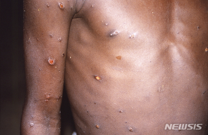 This 1997 image provided by CDC, shows the right arm and torso of a patient, whose skin displayed a number of lesions due to what had been an active case of monkeypox.  As more cases of monkeypox are detected in Europe and North America in 2022, some scientists who have monitored numerous outbreaks in Africa say they are baffled by the unusual disease&#039;s spread in developed countries.  (CDC via AP)