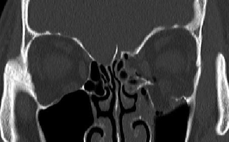증상은 없지만 안와뼈 골절 범위가 매우 넓은 환자의 CT 영상 이미지.(사진 : 김안과병원 제공) *재판매 및 DB 금지