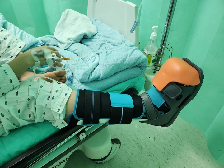[성남=뉴시스] 장모씨의 20대 딸은 이태원 사고로 오른쪽 다리를 다쳐 깁스를 했다. 부친 제공. 2022.10.31. photo@newsis.com *재판매 및 DB 금지