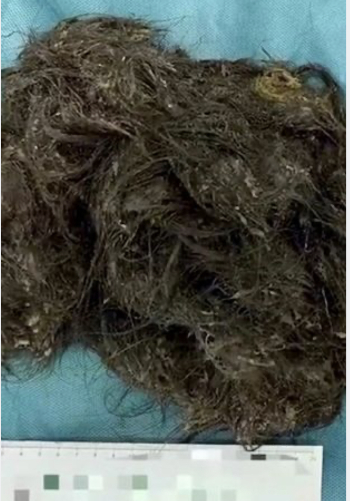 [서울=뉴시스] 이미증을 앓고 있는 중국 소녀의 뱃속에서 머리카락 뭉치 3kg이 발견됐다고 29일(현지시간) 더 미러가 보도했다. <출처 : 데일리 미러 홈페이지 캡처> 2022.12.02. *재판매 및 DB 금지