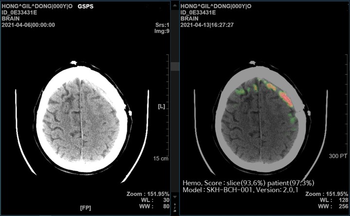 AI 뇌출혈 영상 의료 솔루션 '메디컬 인사이트 플러스 뇌출혈' 데모 화면. (사진=SK C&C 제공) *재판매 및 DB 금지