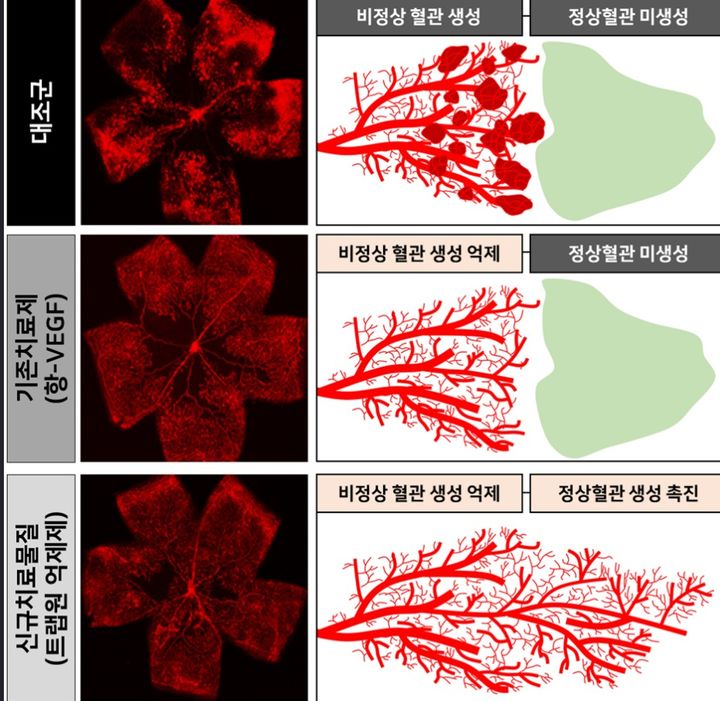 "당뇨 망막병증, 안약으로 개선" 점안형 치료술 개발했다 - 뉴스 썸네일 이미지