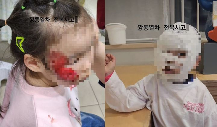 [서울=뉴시스] 경기 포천시의 한 테마파크에서 3세 쌍둥이 여아들이 '깡통열차'를 탔다가 놀이기구가 전복 돼 얼굴과 몸 곳곳에 부상을 입었다.(사진=A씨 인스타그램 캡처) *재판매 및 DB 금지