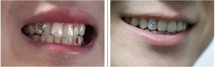 [서울=뉴시스] 12일 치과계는 투스젬은 부착과 제거 시에 강한 산성액 사용, 치아 손상 가능성 등 이유로 시술에 각별히 주의할 것을 당부했다. (사진=한국치과의사협회 제공) 2024.06.11. photo@newsis.com *재판매 및 DB 금지