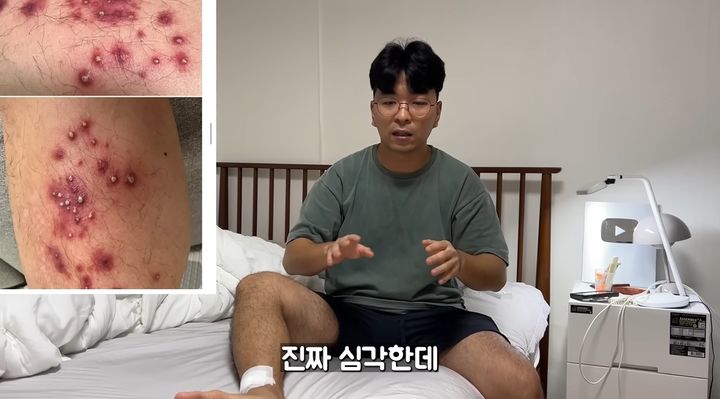 [서울=뉴시스] 구독자 66만명을 보유한 유명 여행 유튜버가 최근 동남아시아에서 발 마사지를 받았다가 심각한 피부 감염으로 항생제 치료를 받고 수술까지 받게 된 사연을 공개하며 주의를 당부했다. (사진=유튜브 'Joe튜브') *재판매 및 DB 금지