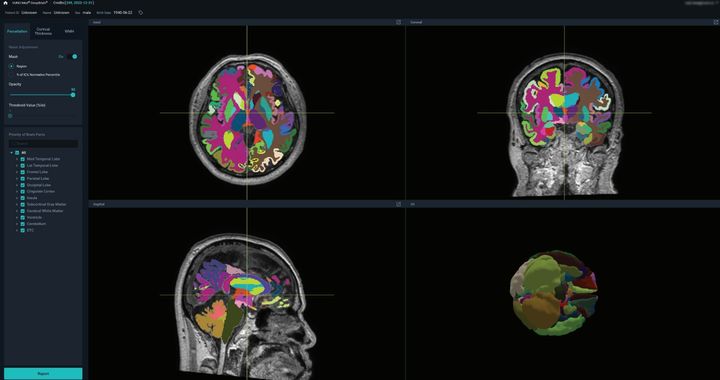 [서울=뉴시스] 23일 의료 AI 기업 뷰노는 올해 알츠하이머 분야 세계 최대 글로벌 학회인 알츠하이머협회 국제컨퍼런스 AAIC(Alzheimer’s Association International Conference)에 참가하고 AI기반 뇌 정량화 의료기기 뷰노메드 딥브레인을 미국 시장에 공식 런칭한다고 밝혔다. (사진=뷰노 제공) 2024.07.23. photo@newsis.com *재판매 및 DB 금지