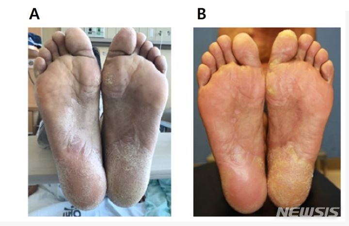 [서울=뉴시스]혈액암 치료 중 발생하는 심각한 합병증인 만성 이식편대숙주질환(cGVHD, Chronic Graft-versus-Host Disease) 환자에게 골수 유래 중간엽 줄기세포(MSCs, Mesenchymal Stem Cells)를 반복 투여해 안전하고 효과적으로 치료할 수 있다는 연구 결과가 나왔다. 사진은 골수 유래 중간엽 줄기세포 치료 전후의 피부 변화. (사진= 서울성모병원 제공) 2024.07.23. photo@newsis.com. 