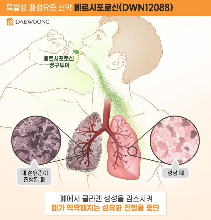 [서울=뉴시스] 대웅제약 베르시포로신(DWN12088) 작용 기전. (사진=뉴시스 DB) photo@newsis.com *재판매 및 DB 금지