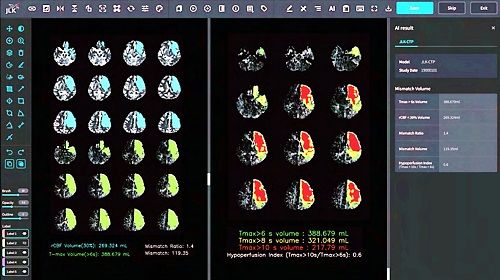 뇌 관류영상 분석 AI 솔루션 JLK-CTP(사진=제이엘케이 제공) *재판매 및 DB 금지