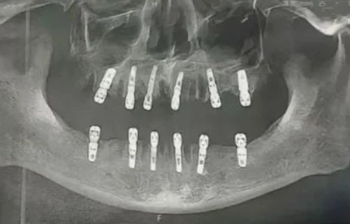 [서울=뉴시스] 중국에서 하루에 23개의 치아를 뽑고 임플란트 12개를 이식한 남성이 치통을 호소하다 심장마비로 사망하는 사건이 발생했다. (사진=더 타이거) *재판매 및 DB 금지