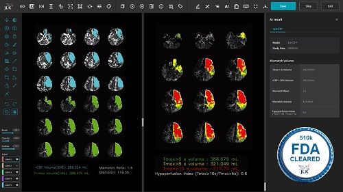 뇌 CT 관류영상 분석 AI 솔루션 JLK-CTP. (사진=제이엘케이 제공) *재판매 및 DB 금지