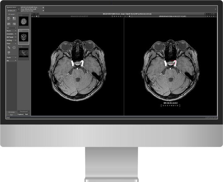 [서울=뉴시스] 1일 딥노이드는 뇌동맥류 진단보조 AI솔루션 '딥뉴로(DEEP:NEURO)'가 비급여 코드를 획득했다고 밝혔다. (사진=딥노이드 제공) 2024.11.01 photo@newsis.com *재판매 및 DB 금지