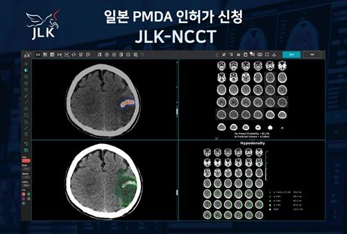 비조영 CT 기반 뇌졸중 솔루션 JLK-NCCT. (사진=제이엘케이 제공) *재판매 및 DB 금지