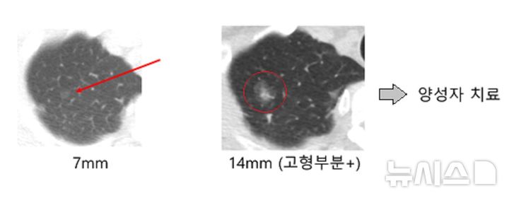 [서울=뉴시스]순수 간유리 폐결절이 안정적인 상태를 유지하다가 10년이 지나서도 자란다는 사실이 처음으로 보고됐다. 사진은 2002년 저선량 흉부 CT 검사에서 7mm 크기의 결절을 발견한(사진 왼쪽 빨간색 화살표 표시) 환자의 영상 검사 결과다. 연구팀은 이 환자를 주기적으로 검사하면서 추적 관찰한 결과 133개월만에 크기 변화(사진 오른쪽의 빨간색 원 안)를 확인하고 양성자로 치료했다. (사진= 삼성서울병원 제공) 2024.11.21. photo@newsis.com. 