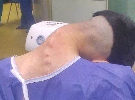 [뉴시스]이란의 20대 청년이 마약 중독 탓에 목이 90도 가까이 꺾이는 '머리떨굼증후군' 증상을 겪는 이례적인 사례가 보고됐다. (사진=데일리메일) 2025.5.15 *재판매 및 DB 금지