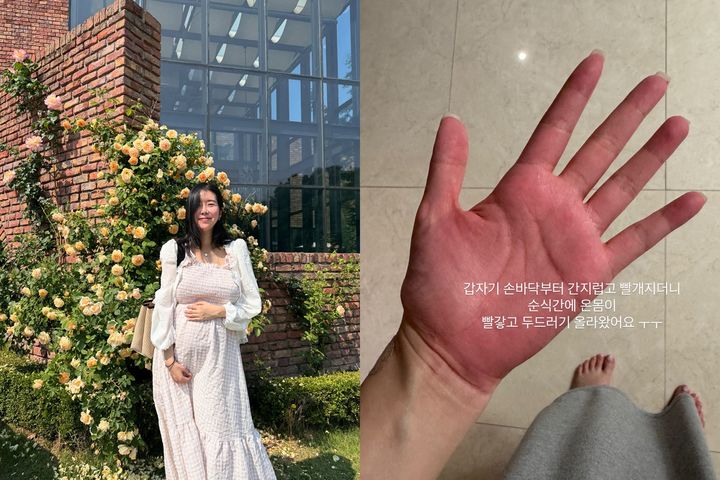'쌍둥이 임신' 김지혜, 항생제 부작용으로 응급실…