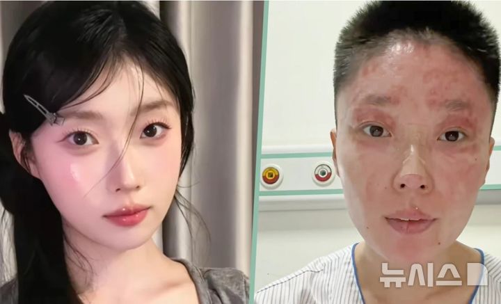 가스 폭발로 얼굴 잃었지만, 17만명 팬 생겨…어떻게?